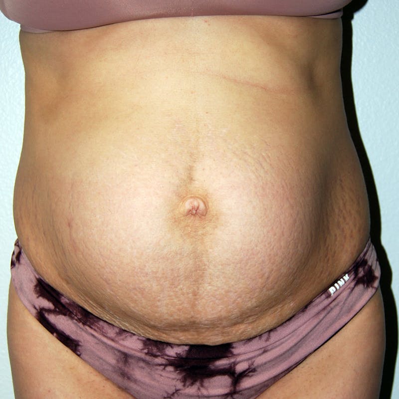 Abdominoplasty Before & After Gallery - Patient 420549 - Image 1