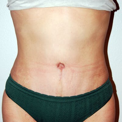 Abdominoplasty Before & After Gallery - Patient 420549 - Image 2