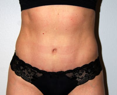 Abdominoplasty Before & After Gallery - Patient 332059 - Image 2