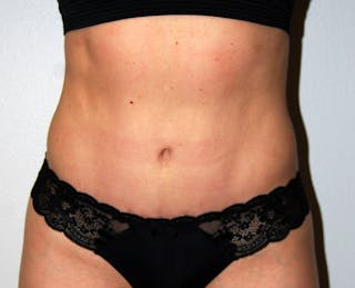 Abdominoplasty Before & After Gallery - Patient 332059 - Image 2