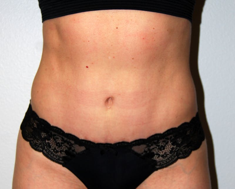 Abdominoplasty Before & After Gallery - Patient 332059 - Image 2