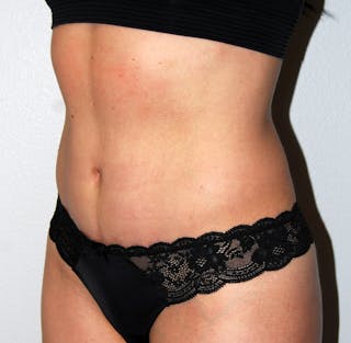 Abdominoplasty Before & After Gallery - Patient 332059 - Image 4