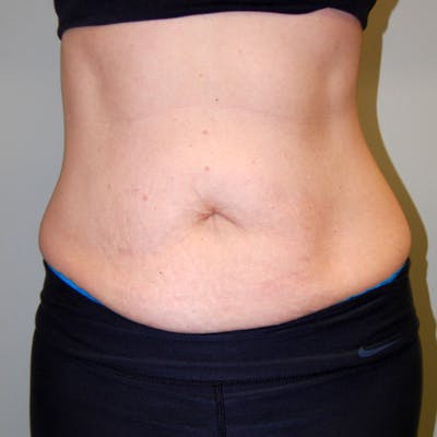 Abdominoplasty Before & After Gallery - Patient 422593 - Image 1