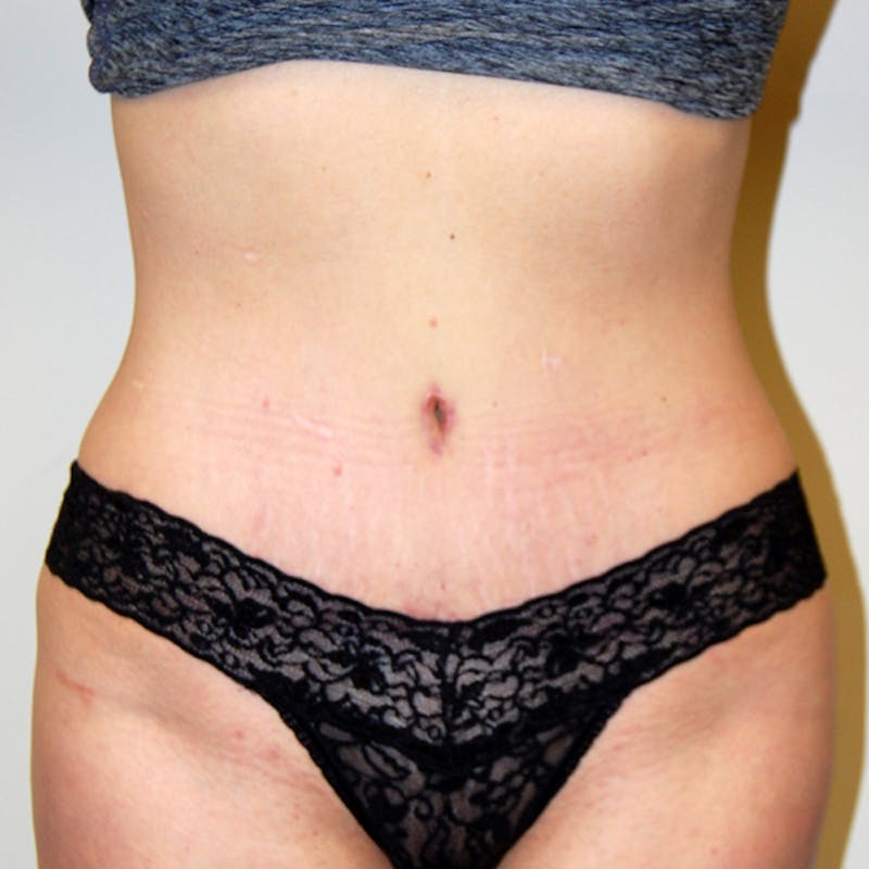 Abdominoplasty Before & After Gallery - Patient 422593 - Image 2