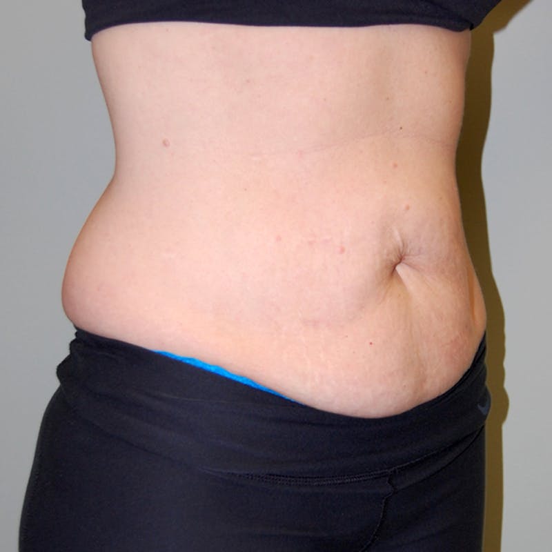 Abdominoplasty Before & After Gallery - Patient 422593 - Image 3