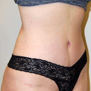 Abdominoplasty Before & After Gallery - Patient 422593 - Image 4
