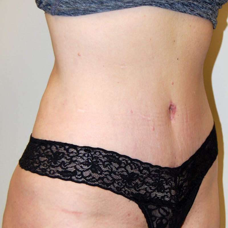 Abdominoplasty Before & After Gallery - Patient 422593 - Image 4