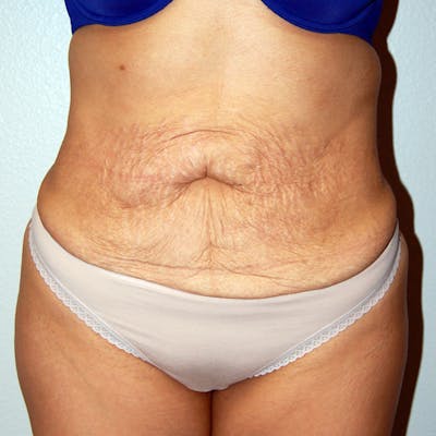 Abdominoplasty Before & After Gallery - Patient 181926 - Image 1