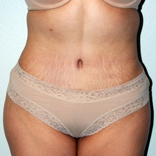 Abdominoplasty Before & After Gallery - Patient 181926 - Image 2