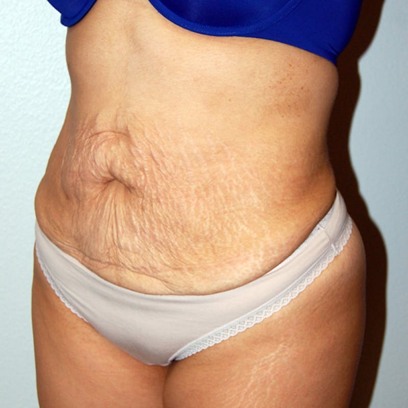 Abdominoplasty Before & After Gallery - Patient 181926 - Image 3