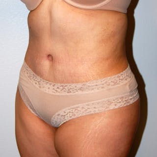 Abdominoplasty Before & After Gallery - Patient 181926 - Image 4