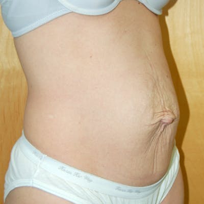 Abdominoplasty Before & After Gallery - Patient 125168 - Image 1