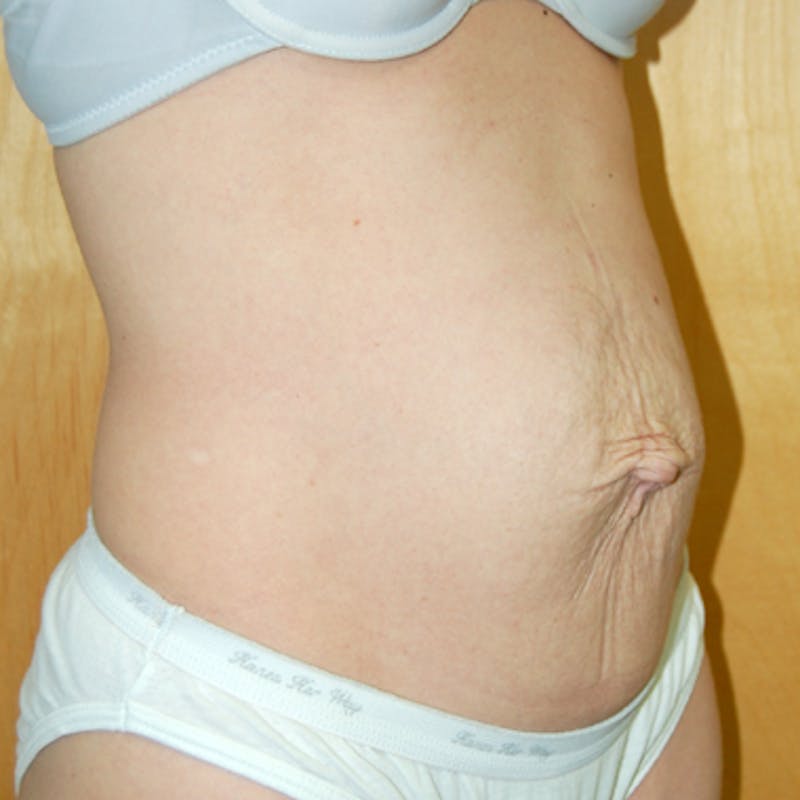 Abdominoplasty Before & After Gallery - Patient 125168 - Image 1