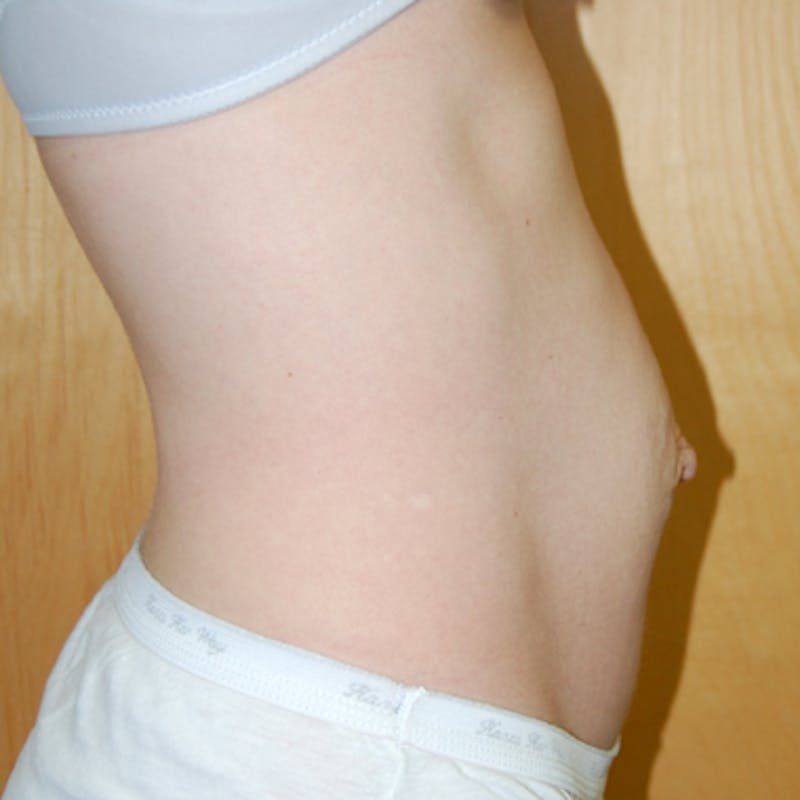 Abdominoplasty Before & After Gallery - Patient 125168 - Image 3