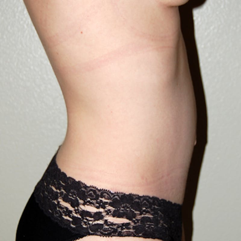 Abdominoplasty Before & After Gallery - Patient 125168 - Image 4
