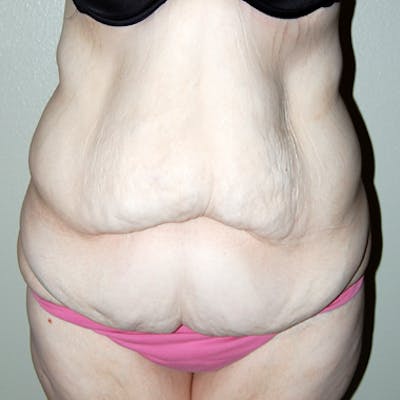 Abdominoplasty Before & After Gallery - Patient 419645 - Image 1
