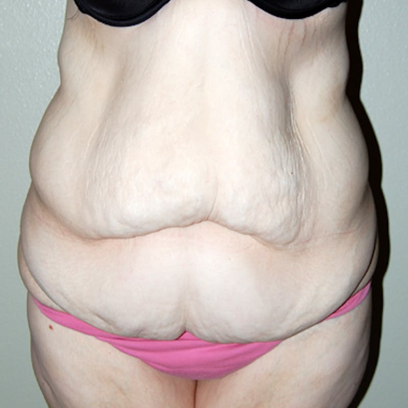 Abdominoplasty Before & After Gallery - Patient 419645 - Image 1