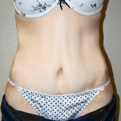 Abdominoplasty Before & After Gallery - Patient 419645 - Image 2