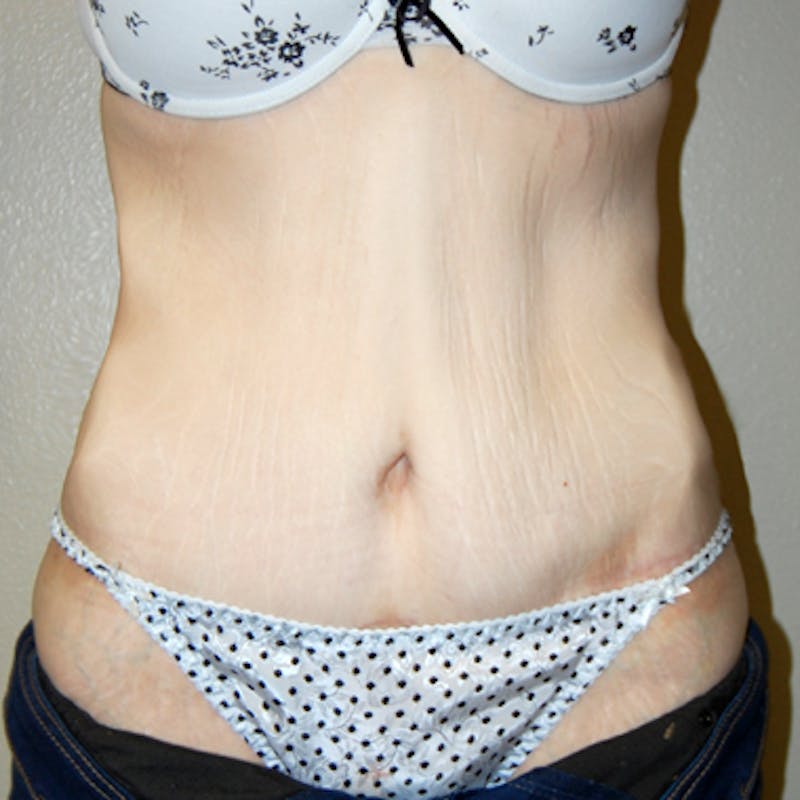 Abdominoplasty Before & After Gallery - Patient 419645 - Image 2