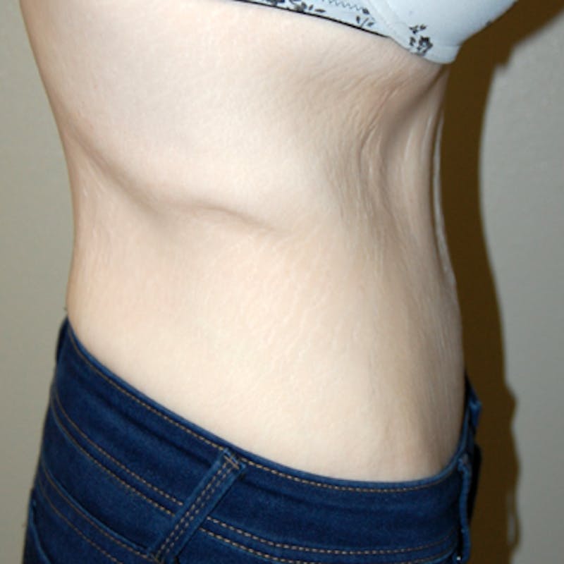 Abdominoplasty Before & After Gallery - Patient 419645 - Image 4