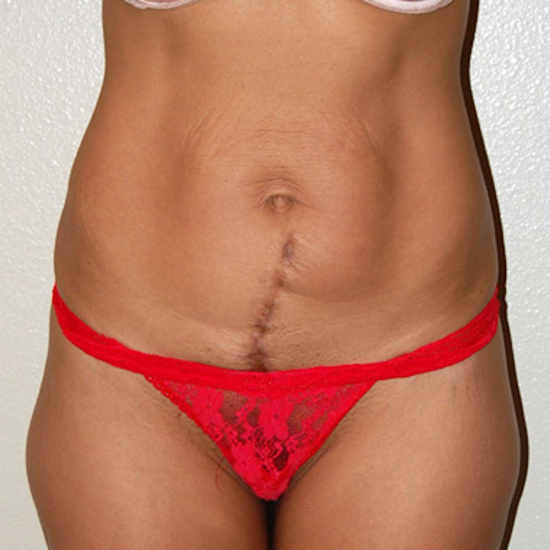 Abdominoplasty Before & After Gallery - Patient 229248 - Image 1