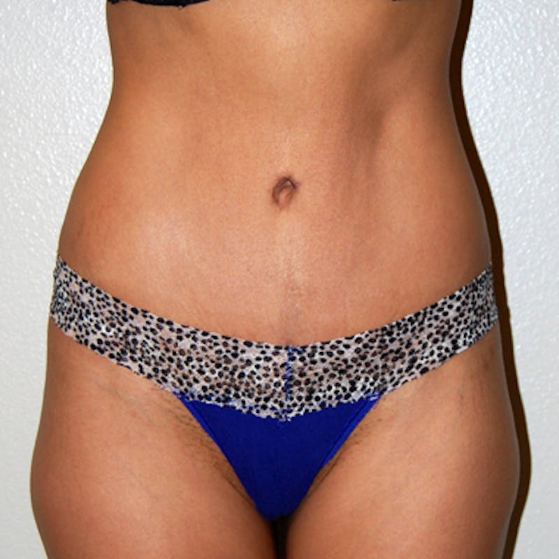 Abdominoplasty Before & After Gallery - Patient 229248 - Image 2