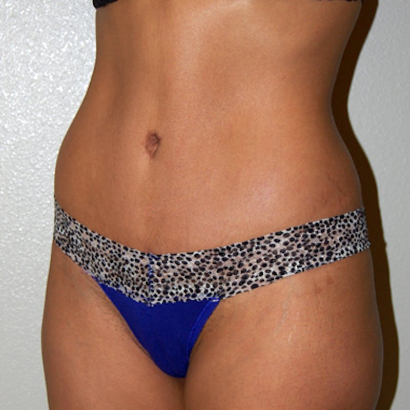 Abdominoplasty Before & After Gallery - Patient 229248 - Image 4