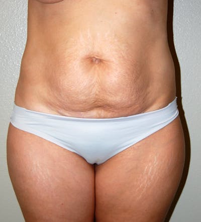 Abdominoplasty Before & After Gallery - Patient 425917 - Image 1