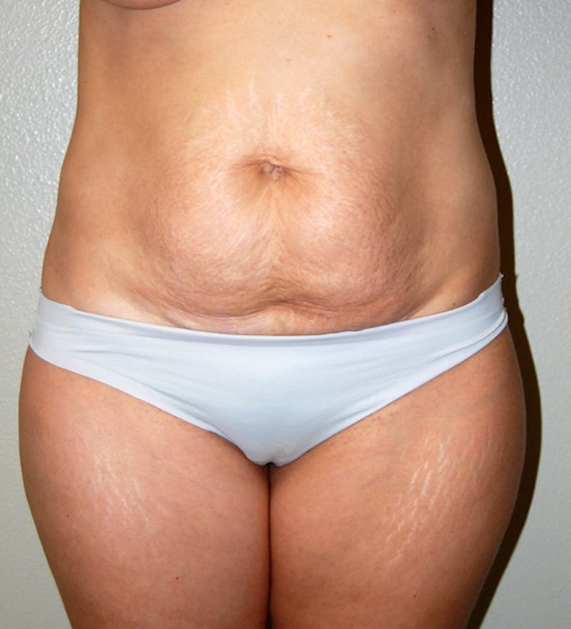 Abdominoplasty Before & After Gallery - Patient 425917 - Image 1