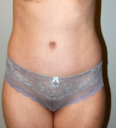 Abdominoplasty Before & After Gallery - Patient 425917 - Image 2