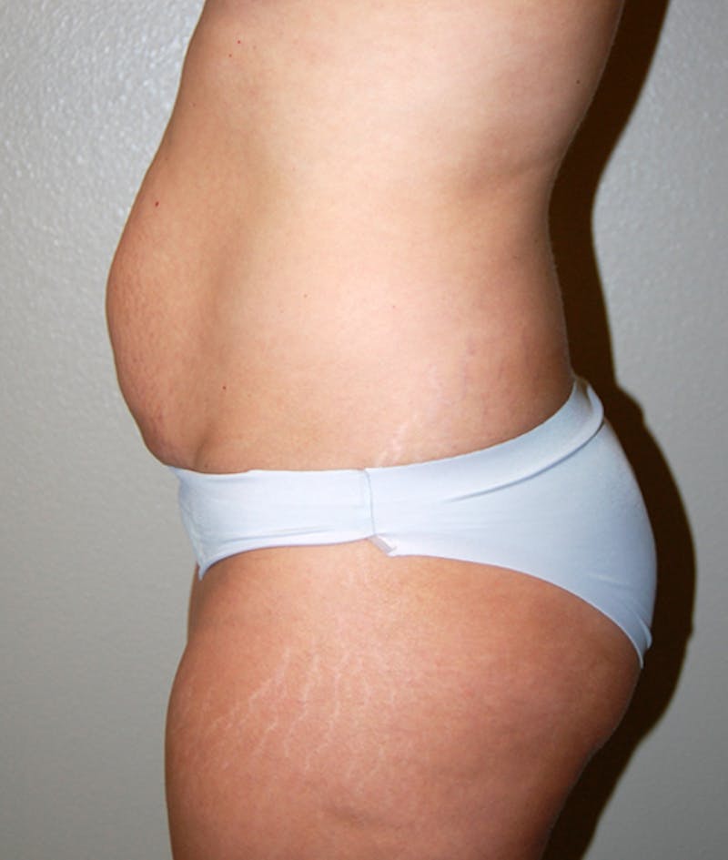 Abdominoplasty Before & After Gallery - Patient 425917 - Image 3