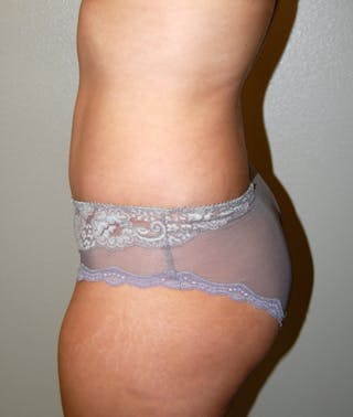 Abdominoplasty Before & After Gallery - Patient 425917 - Image 4