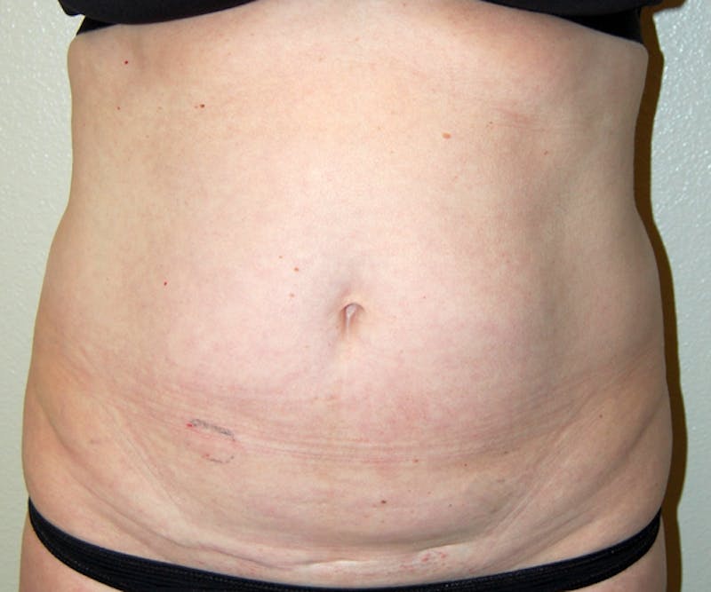 Abdominoplasty Before & After Gallery - Patient 357861 - Image 1