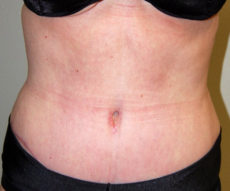 Abdominoplasty Before & After Gallery - Patient 357861 - Image 2