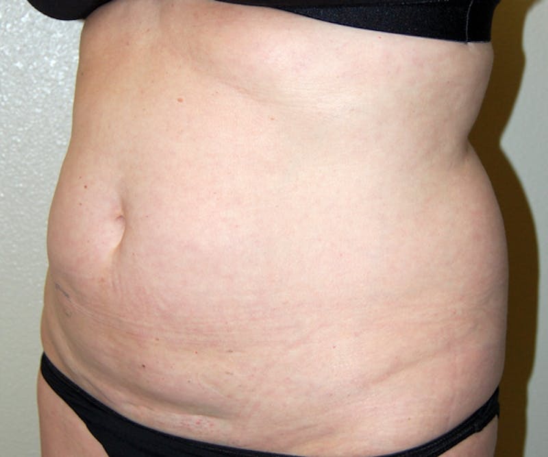 Abdominoplasty Before & After Gallery - Patient 357861 - Image 3