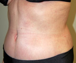Abdominoplasty Before & After Gallery - Patient 357861 - Image 4