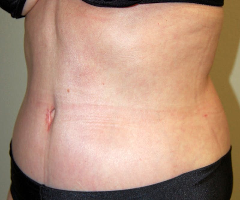 Abdominoplasty Before & After Gallery - Patient 357861 - Image 4
