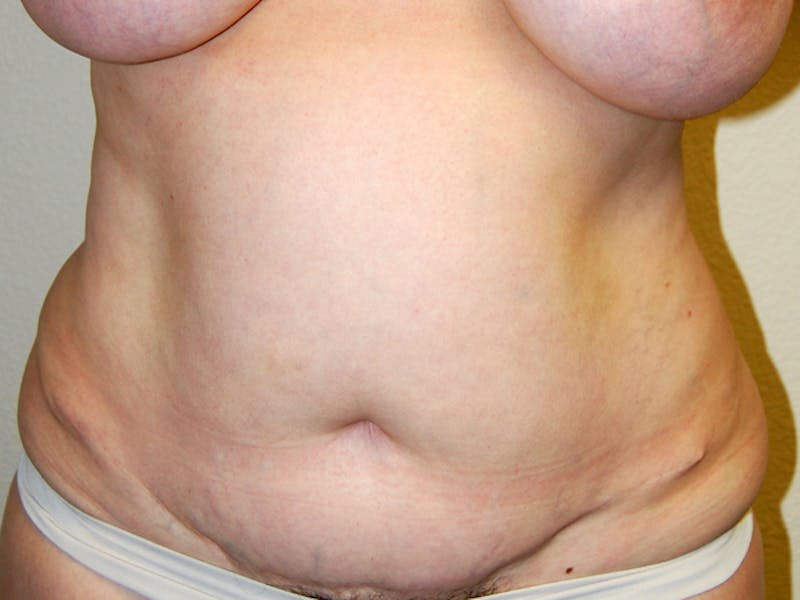 Abdominoplasty Before & After Gallery - Patient 129586 - Image 1