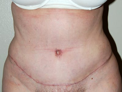 Abdominoplasty Before & After Gallery - Patient 129586 - Image 2