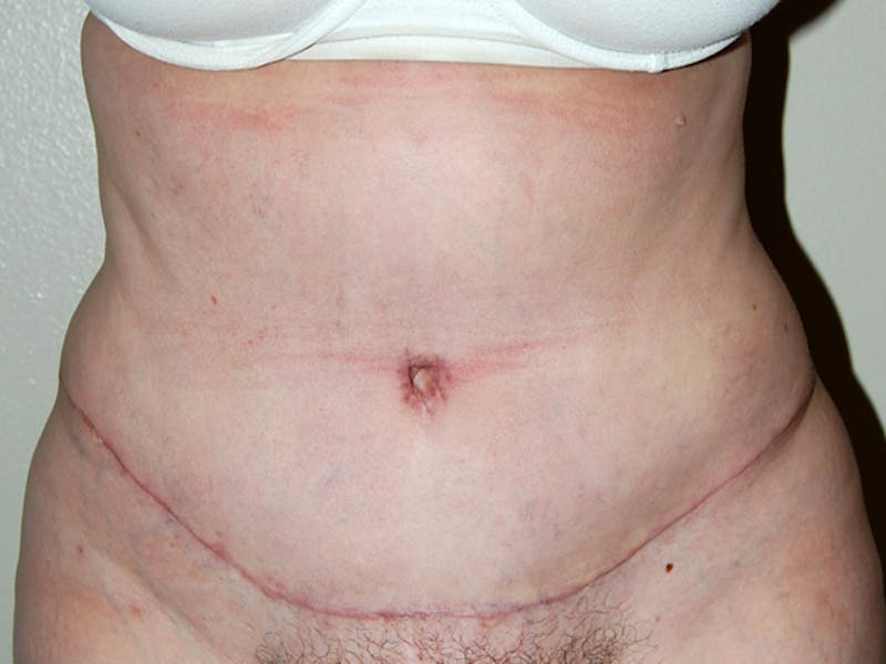 Abdominoplasty Before & After Gallery - Patient 129586 - Image 2