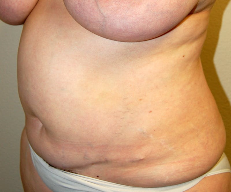Abdominoplasty Before & After Gallery - Patient 129586 - Image 3