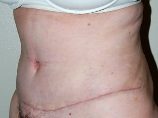 Abdominoplasty Before & After Gallery - Patient 129586 - Image 4