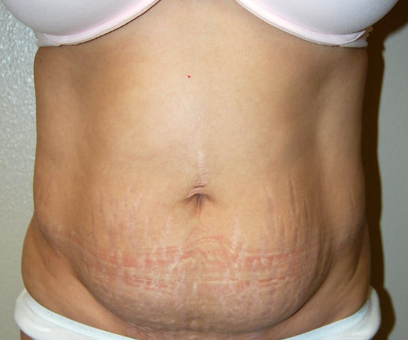 Abdominoplasty Before & After Gallery - Patient 279528 - Image 1