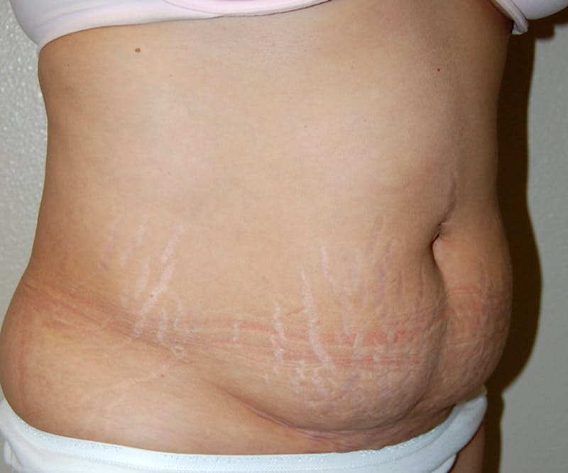 Abdominoplasty Before & After Gallery - Patient 279528 - Image 3