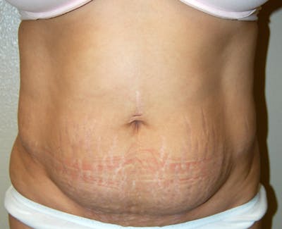 Abdominoplasty Before & After Gallery - Patient 133074 - Image 1