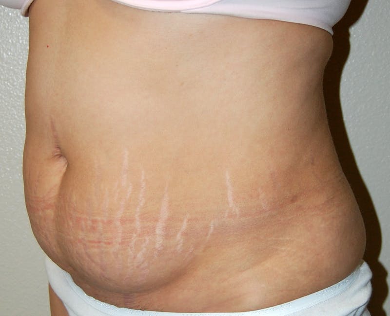 Abdominoplasty Before & After Gallery - Patient 133074 - Image 3