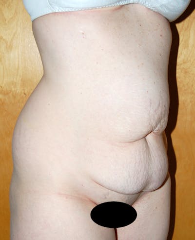 Abdominoplasty Before & After Gallery - Patient 347357 - Image 1