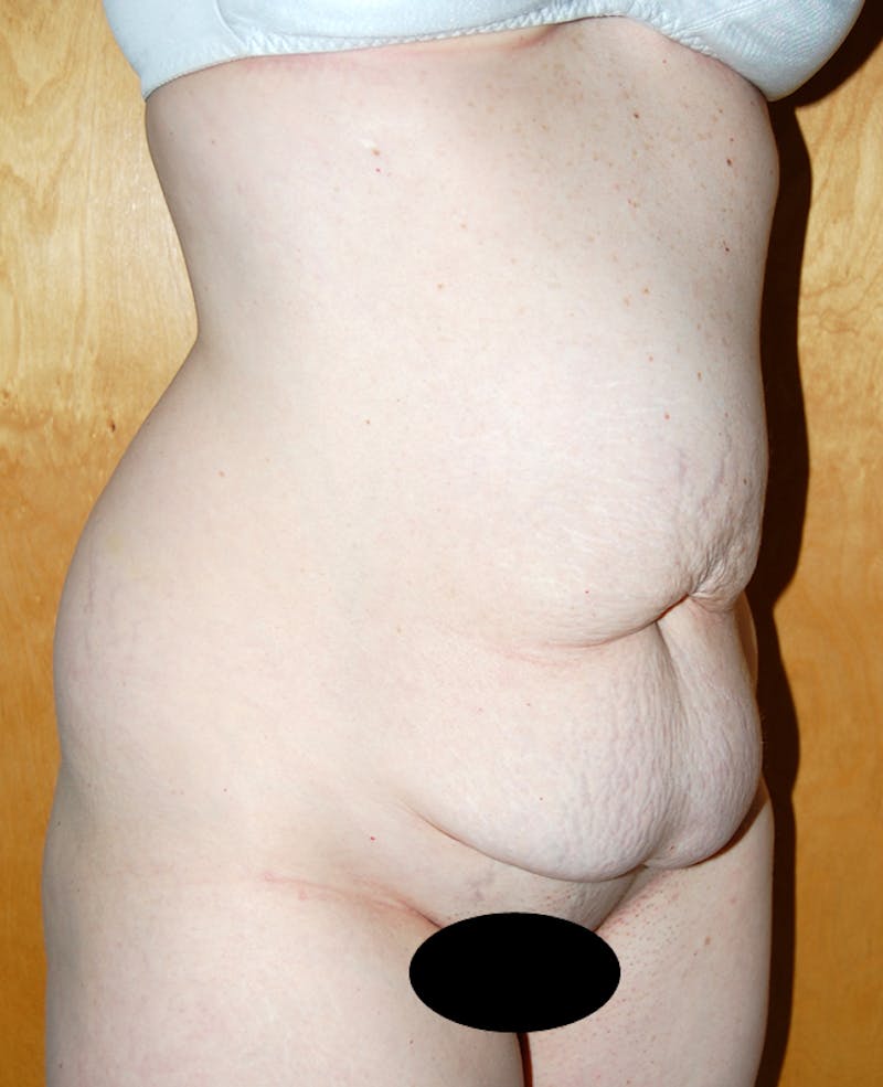 Abdominoplasty Before & After Gallery - Patient 347357 - Image 1