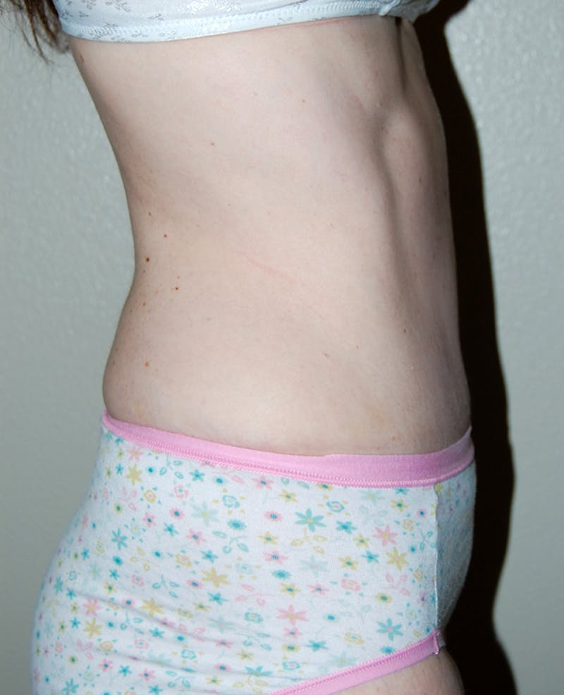 Abdominoplasty Before & After Gallery - Patient 347357 - Image 4