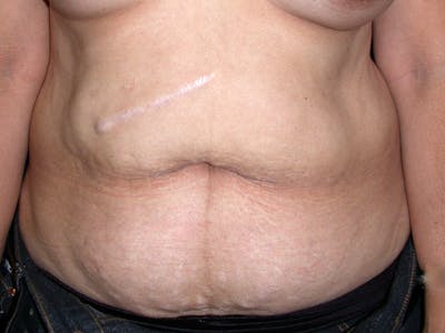 Abdominoplasty Before & After Gallery - Patient 188562 - Image 1